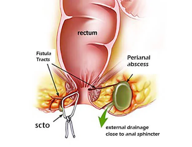 Why Does an Anal Fistula Return After Surgery?