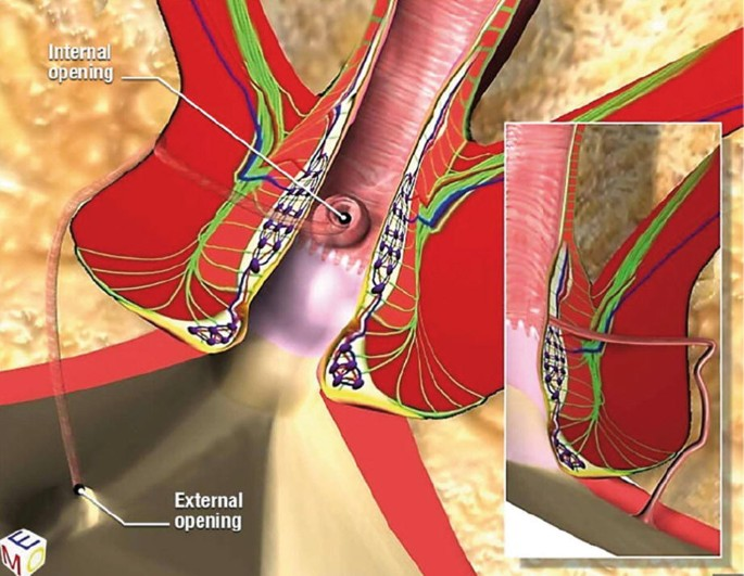 VAAFT: A Modern, Minimally Invasive Solution for Anal Fistula