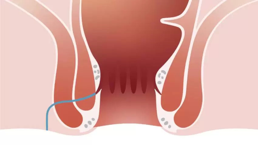 What Is VAAFT and How Does It Treat Fistula-in-Ano