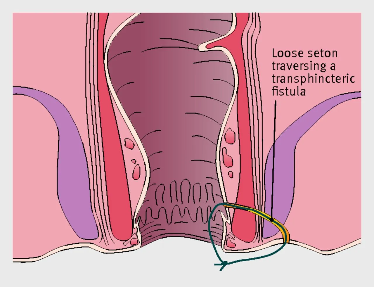 What is Anal Fistula? Causes, Symptoms & Treatment Options