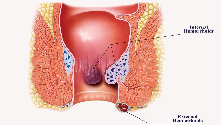 Pus Discharge Near the Anus