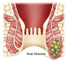 Anorectal Abscess Diagram